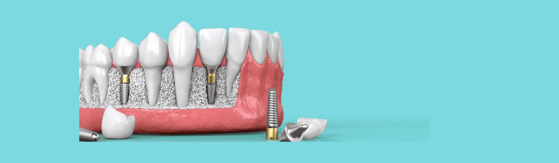 What Is a Dental Implant?